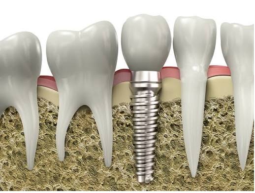 Dentist Supports